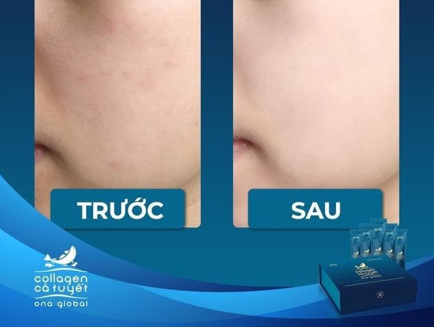 Hình ảnh so sánh trước và sau khi sử dụng collagen cá tuyết ona global