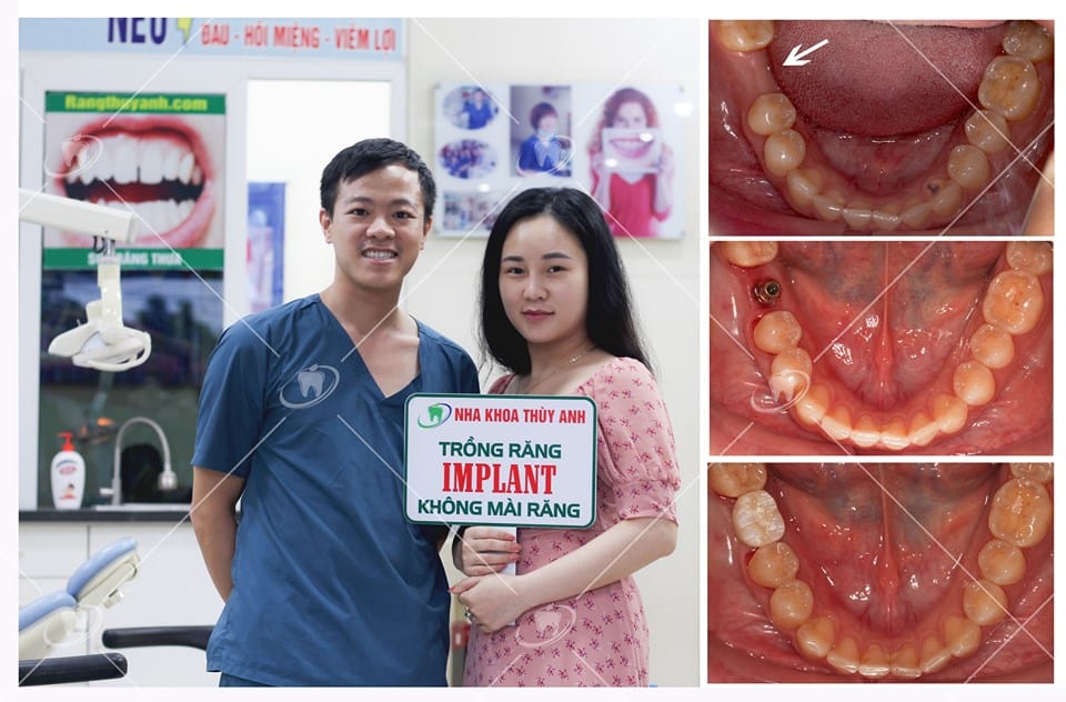 gia trong rang implant 4 1