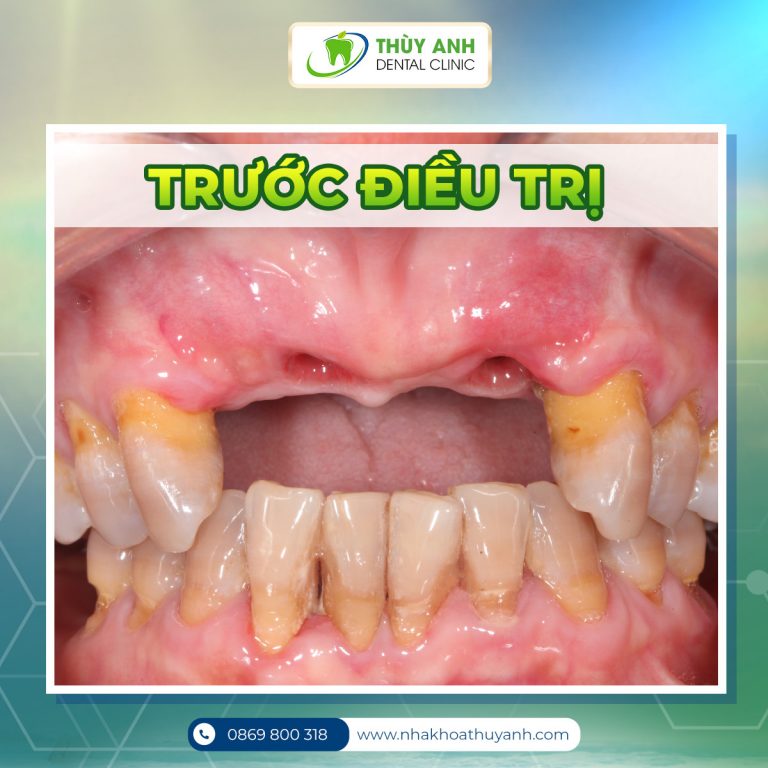 trong rang cua gia bao nhieu 768x768 1