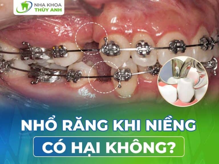 nho rang khi nieng co hai khong 768x576 1