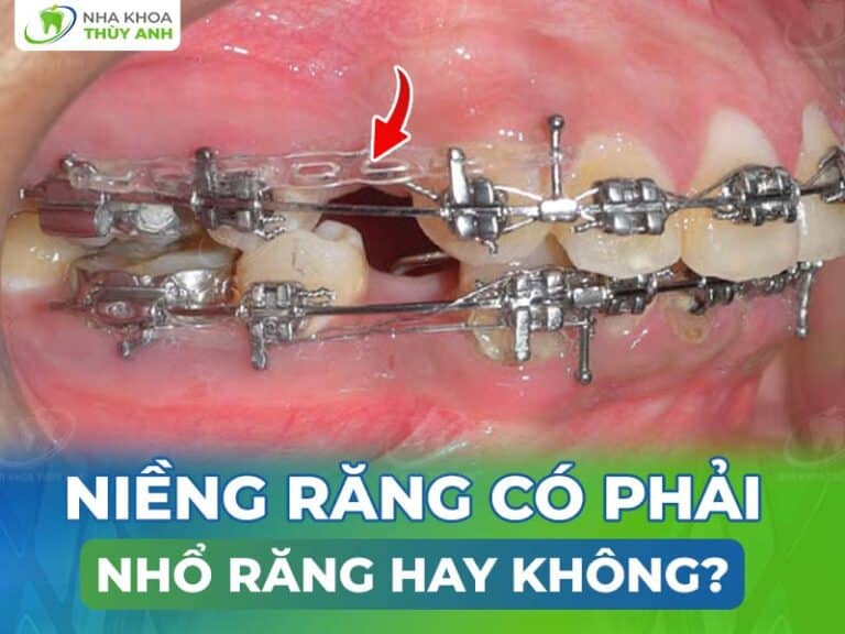 nieng rang co phai nho rang khong 768x576 1