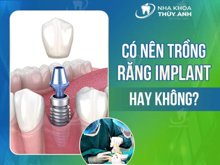co nen trong rang implant khong