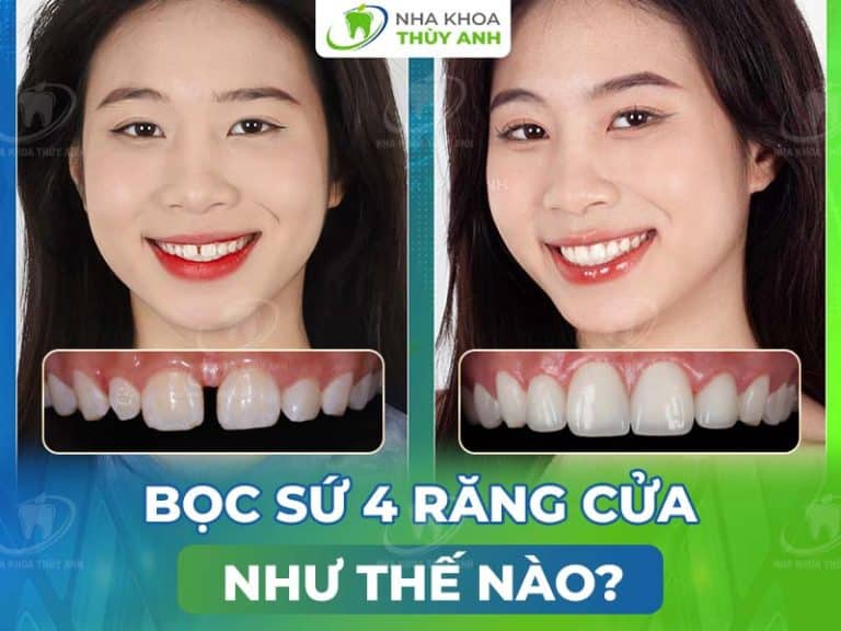 boc rang su 4 rang cua nhu the nao 768x576 1
