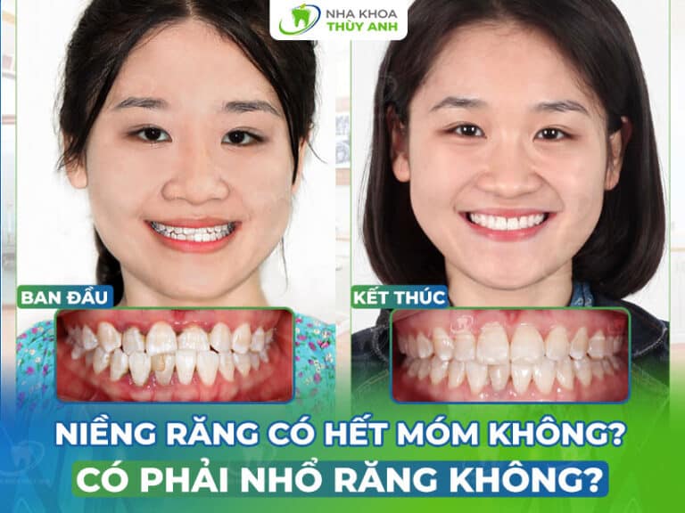 nieng rang co het mom khong 768x576 1
