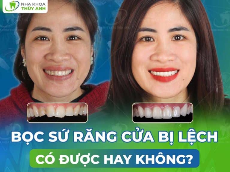 boc su rang cua bi lech co duoc khong 768x576 1