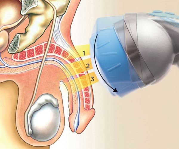 eswt treatment 1 0